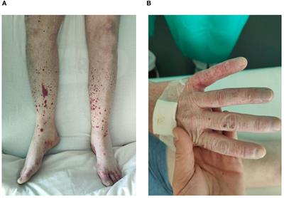 Cryoglobulinemic vasculitis triggered by Staphylococcus aureus endocarditis with chronic hepatitis C virus co-infection: a case report and literature review